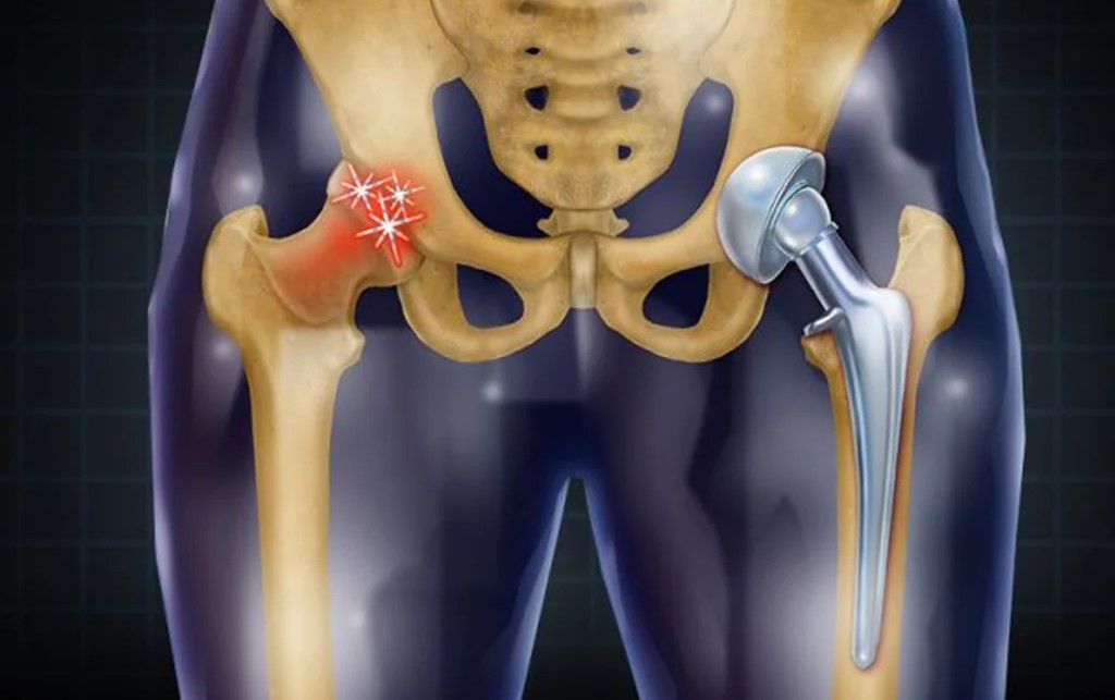 علاج خشونة الحوض وجراحات مفصل الحوض الصناعي